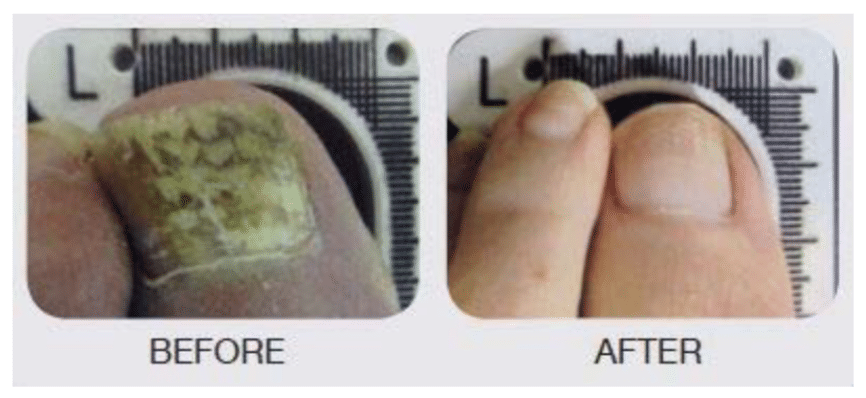 Lunula Laser Webinar
